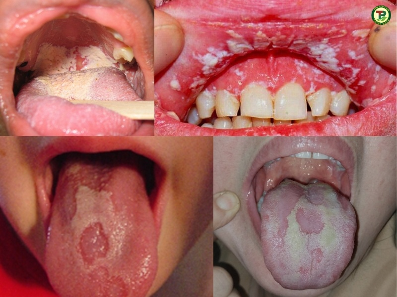 Nấm Miệng: Nguyên Nhân Triệu Chứng Và Cách Điều Trị